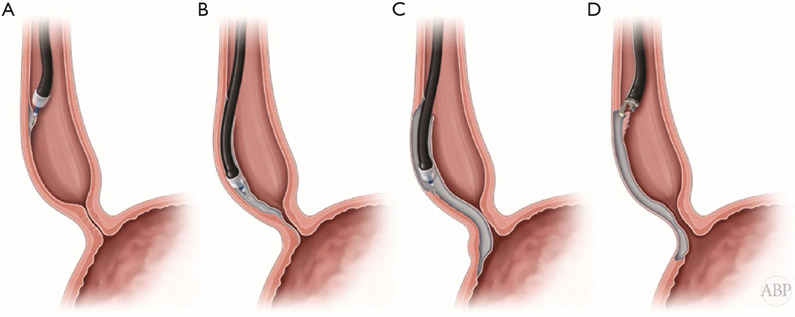 Best Gastroenterologist in Max Super Speciality Hospital patpargan